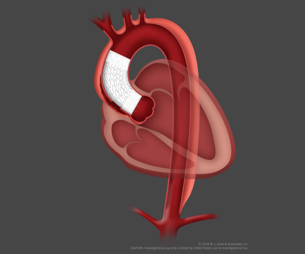 Gore Ascending Stent Graft