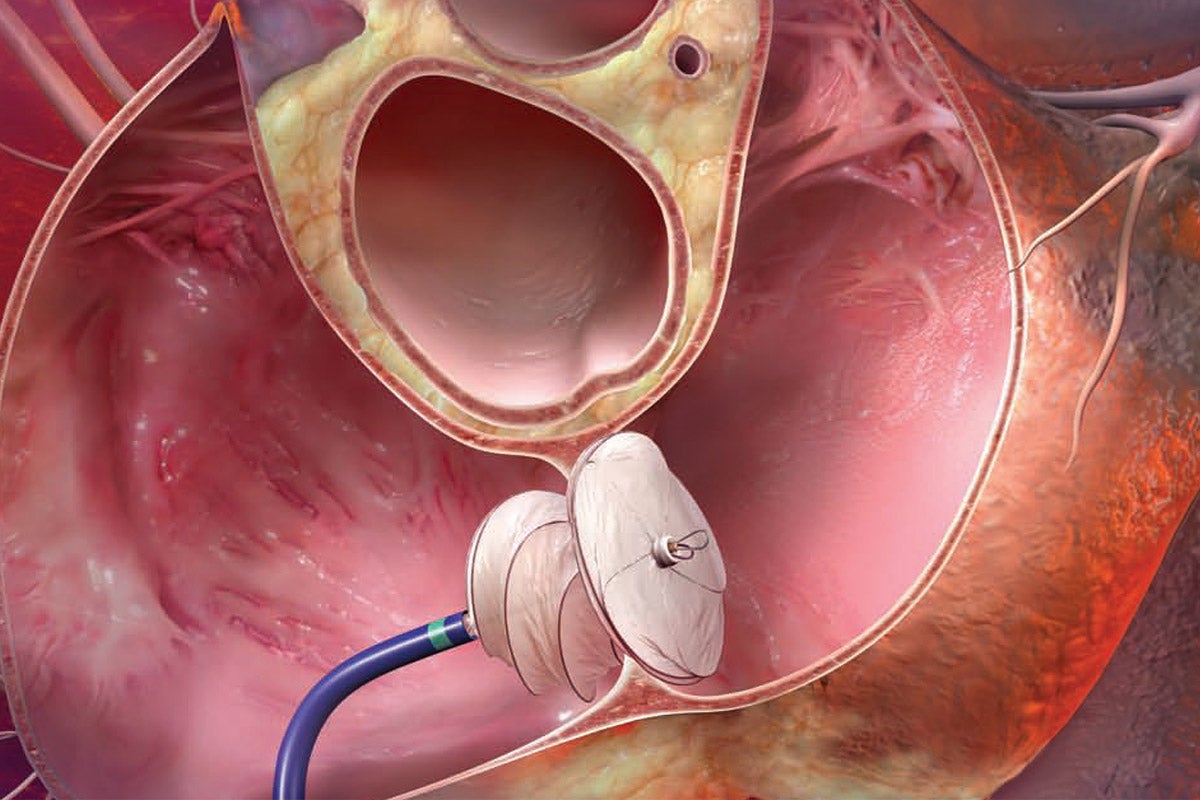 GORE HELEX Septal Occluder fixing a congenital heart defect.